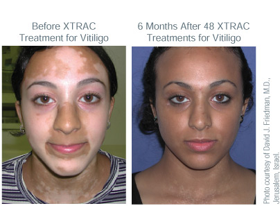For the Treatment of Vitiligo