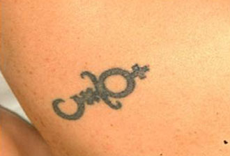 Tattoo Removal with Quanta Q-Plus C™