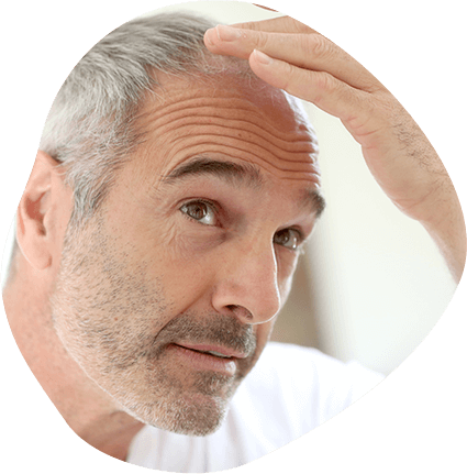 Hair Loss and Hair Restoration