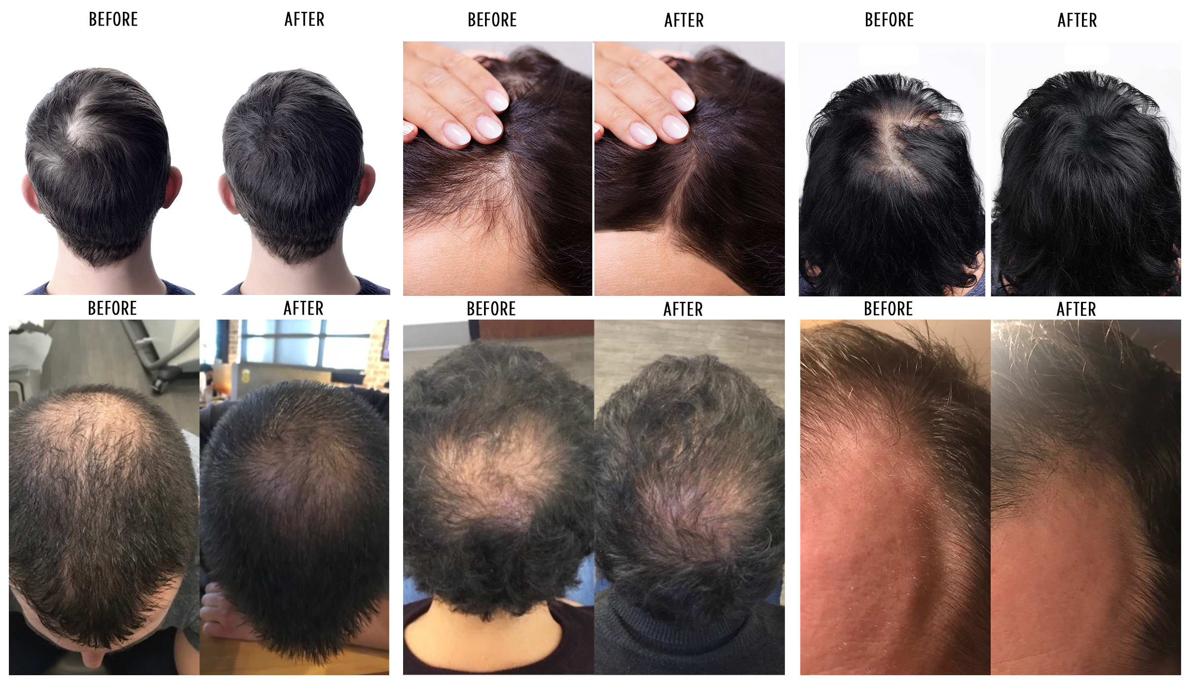 Platelet-Rich Plasma (PRP) Therapy for Hair Loss | Advanced Dermatology