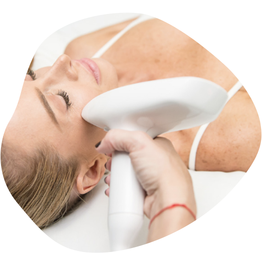 Venus Viva™ Nanofractional Radio Frequency (RF) with Microneedling 