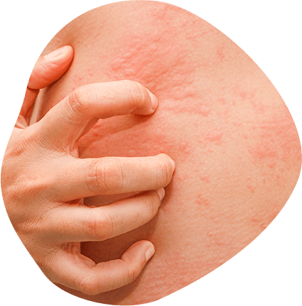 Quick Relief & Indentifying What Triggers Hives for You