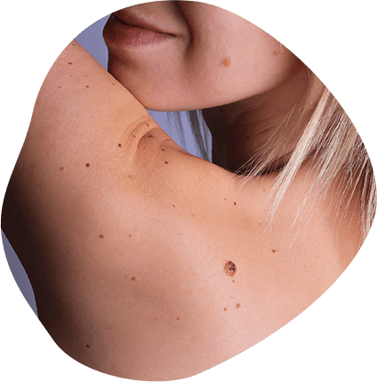 What are the benefits of Mohs Surgery