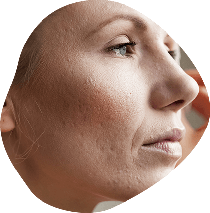 dermabrasion near me