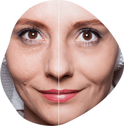 Radio Frequency with Microneedling