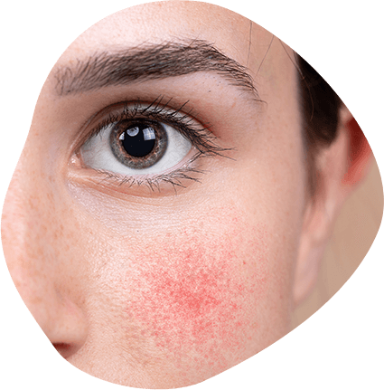 What Does Rosacea Look Like