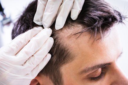 Thinning Hair and Hair Loss: When to See a Dermatologist | Advanced  Dermatology