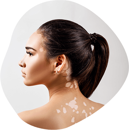 Vitiligo Dermatologist & Specialist | Advanced Dermatology Vitiligo Dermatologist & Specialist | Advanced Dermatology