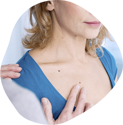 Managing Atypical Nevi