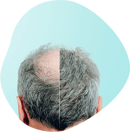 Hair Restoration & Transplant Surgery | Get Results | ADCS Hair Restoration & Transplant Surgery | Get Results | ADCS