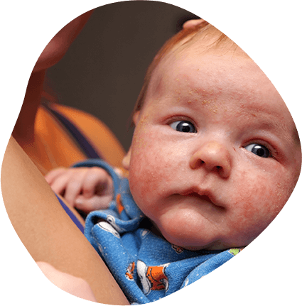 How do you Treat Eczema